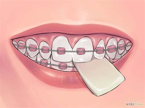 So why hesitate call us now. 4 Ways to Deal with Braces - wikiHow