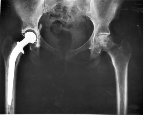 Hip Replacement Surgery At Praram 9 Hospital