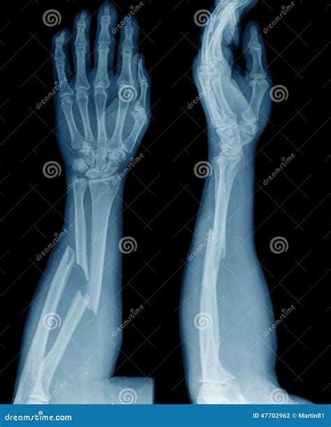 X Ray Of Broken Arm Royalty Free Stock Image 47702962
