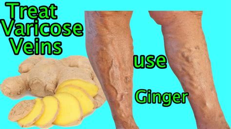Natural Home Remedies For Varicose Veins With Ginger 2020 Youtube