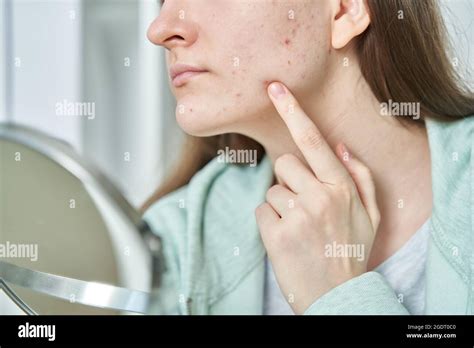 Portrait Of Young Teenage Girl Having Problems With Skin Checking And