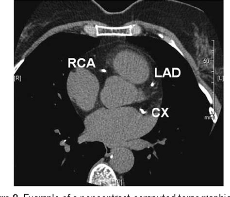 Figure 2 From Role Of Computed Tomography For Diagnosis And Risk