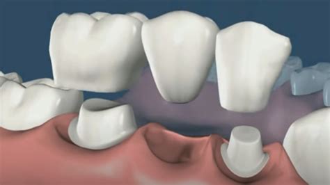 Todo sobre los puentes dentales Clínica Dental en Dos Hermanas