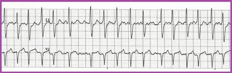As you move along the rhythm strip, you can then see if the pr interval changes, if qrs complexes are missing or if there is complete dissociation between the two. Float Nurse: Practice EKG Rhythm Strips 190