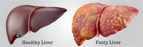 How To Fix Your Fatty Liver Fix Your Fatty Liver