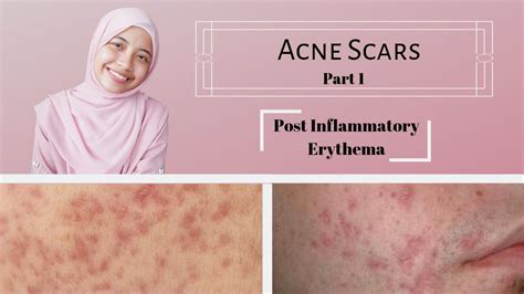 Acne Scars Part 1 Post Inflammatory Erythema Youtube