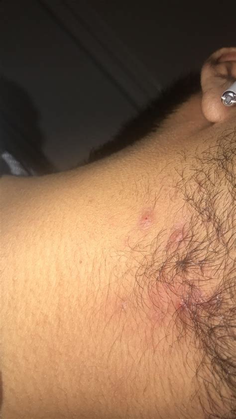 What Are These Bumps On Neck Acne