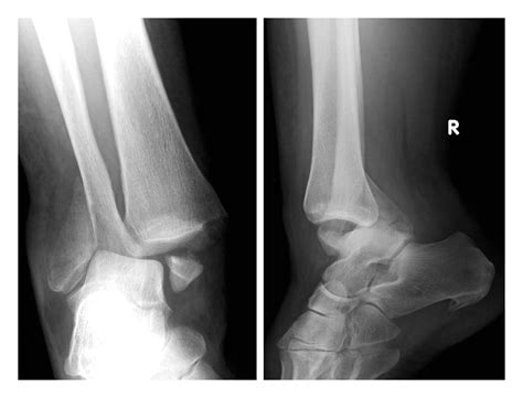 Acutely Irreducible Ankle Fracture Dislocation A Report Of A Bosworth