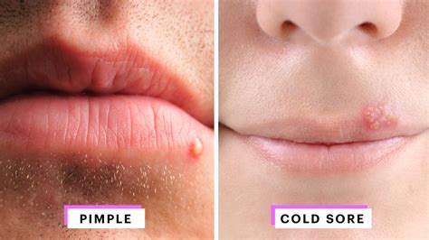 Herpes On Lips Stages