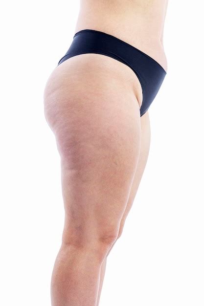 Premium Photo Overweight Woman With Cellulite And Varicose Veins On Her Legs And Stretch Marks