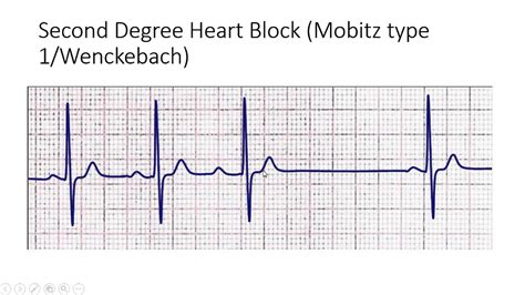 Study Medical Photos Ecg Findings In Different Types Of Heart Block