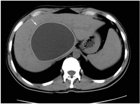 Type I Hydatid Cyst Of The Liver In An 11 Year Old Girl Unenhanced Ct