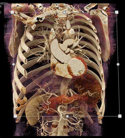 Coarctation Of The Aorta With Multiple Collaterals Cardiac Case