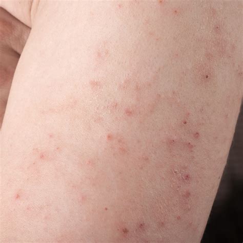 Dermatitis Herpetiformis An Itchy Burning Blistering Rash