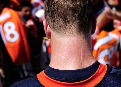 Peyton Manning's Neck Injury