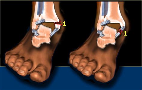 The Radiology Assistant Ankle Fracture Weber And Lauge Hansen Classification