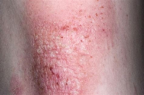 Adult Eczema Pictures Photos