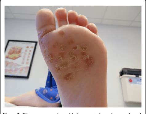 Figure From A Pediatric Case Of Bullous Tinea Pedis Caused By