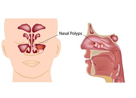 What Are Nasal Polyps Signs Symptoms And Treatment Options BIPmd