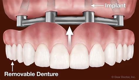 Dental Implants Kelvin B Smith Dds Llc Baltimore Maryland