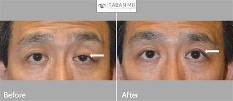 Eyelid Ptosis Droopy Eyelid Surgery Dr Mehryar Ray Taban Md