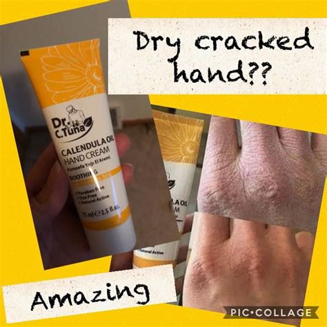 Dry Cracked Hands Video Dry Cracked Hands Cracked Hands Hand Cream