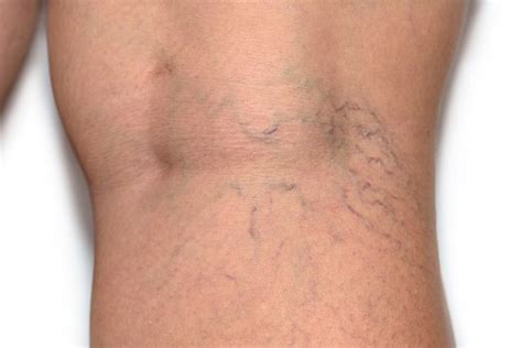 Varicose Veins Can Be More Than A Cosmetic Concern