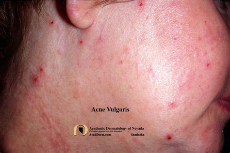 Acne Vulgaris The Good The Bad And The Scarring Academic