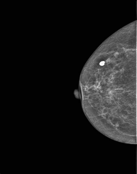 Digital Mammography Machine