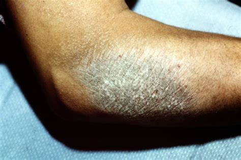 Pict0024 Dermatitis2 Dr Ken Hashimoto Wayne State University