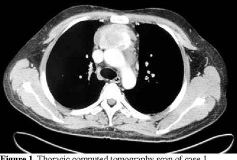 Figure 1 From Atypical Carcinoid Tumor Of The Thymus Two Case Reports