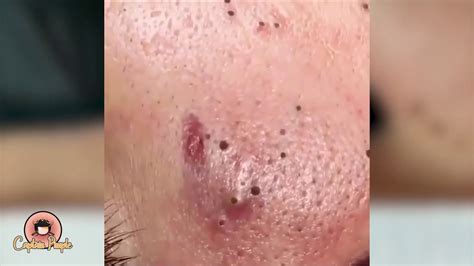 2019 Satisfying Pimple Black Head Popping Youtube