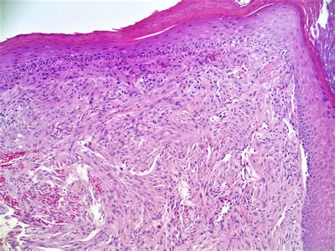 Pathology Outlines Angiofibroma Fibrous Papule