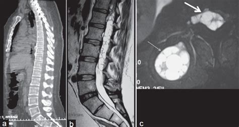 Preoperative Imaging A Sagittal Ct Scan Of The Spine Did Not Show