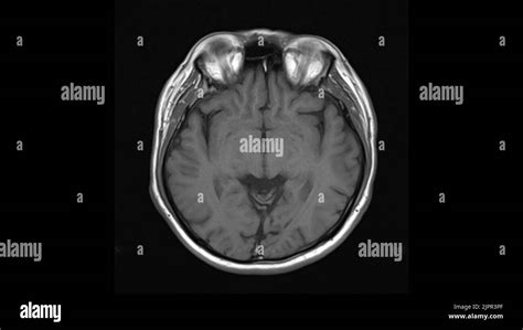 Healthy Human Brain Scan Black And White Stock Photos And Images Alamy