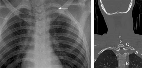 Apical Left Extrapleural Cap An Early And Important Sign On Chest