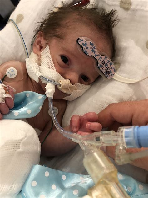 Congenital Diaphragmatic Hernia Cdh And Omphalocele Liams Story