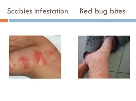 Scabies Vs Bed Bugs How To Tell The Difference Bedbugs