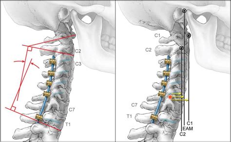 The Impact Of Standing Regional Cervical Sagittal Alignment On Outcomes