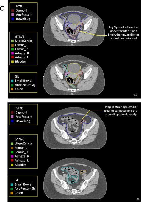 Pelvic Normal Tissue Contouring Guidelines For Radiation Therapy A