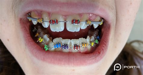 Braces Colors For Teeth