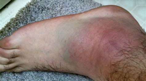How Many Of You Have Ever Deep Bruised An Ankle Bone And No Break