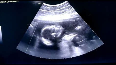Ultrasonido 4d 19 Semanas De Embarazoecografia 4d Youtube