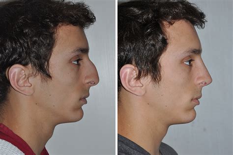 Big Nose Rhinoplasty Before And After Men