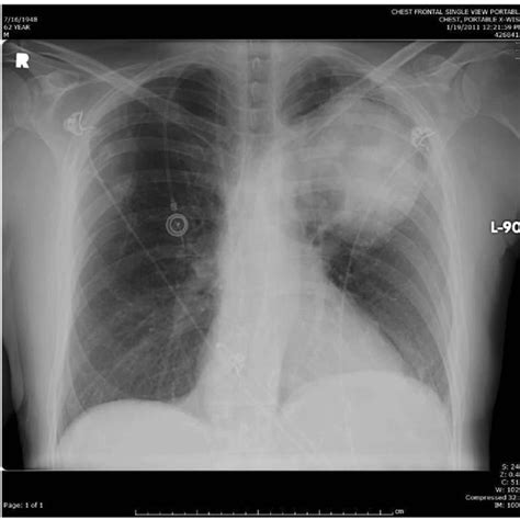 Portable Chest X Ray Showing The Left Upper Lobe Lung Mass Download