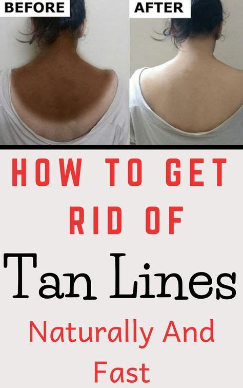 How To Get Rid Of Tan Lines Naturally And Fast Tan Lines Skin Tan Removal