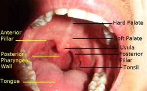 What does mouth cancer look like. 11 Early Signs of Oral Cancer | Beautiful Ala Indonesian