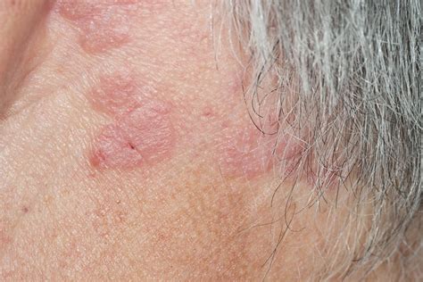 Psoriasis Of The Scalp Stock Image C0230723 Science Photo Library