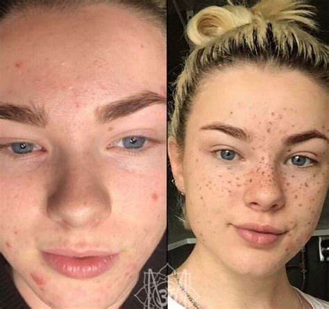 Fake Freckles Beauty Trend Sees Young Girls Tattoo Their Face Style Life And Style Uk