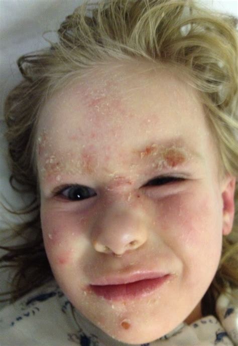 Childrens Experiences Of Eczema In Pictures